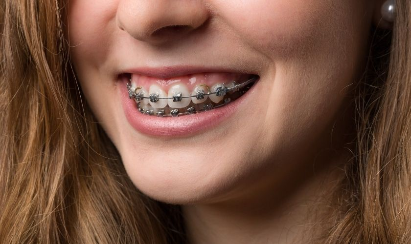 Close-up of a smiling woman wearing metal braces on her teeth